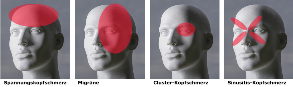 Arten von Kopfschmerzen und wo die Schmerzen dabei vorrangig auftreten