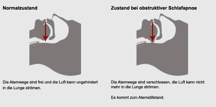 Veranschaulichung von obstruktiver Schlafapnoe